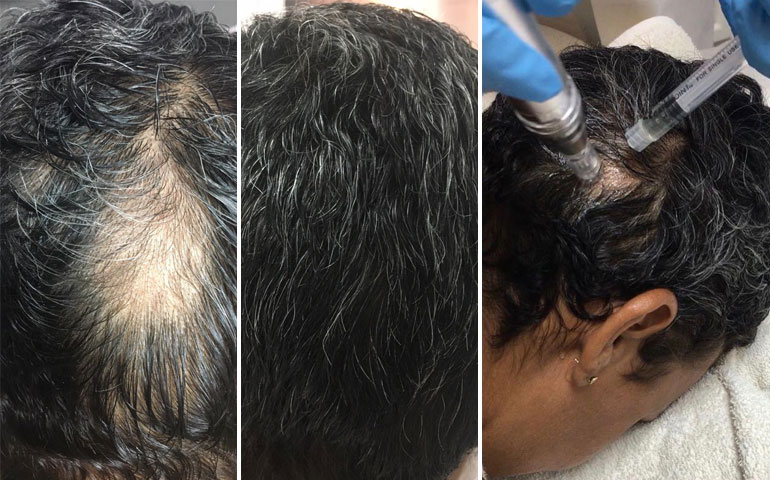Skinique - Non-surgical Hair Restoration